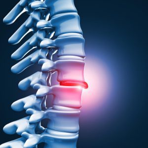 Spinal decompression therapy helps back pain from herniated discs